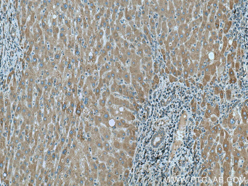 Immunohistochemistry (IHC) staining of human liver cancer tissue using PTPLAD1 Polyclonal antibody (28572-1-AP)