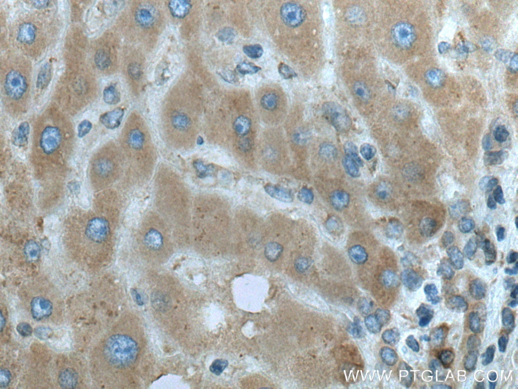 Immunohistochemistry (IHC) staining of human liver cancer tissue using PTPLAD1 Polyclonal antibody (28572-1-AP)