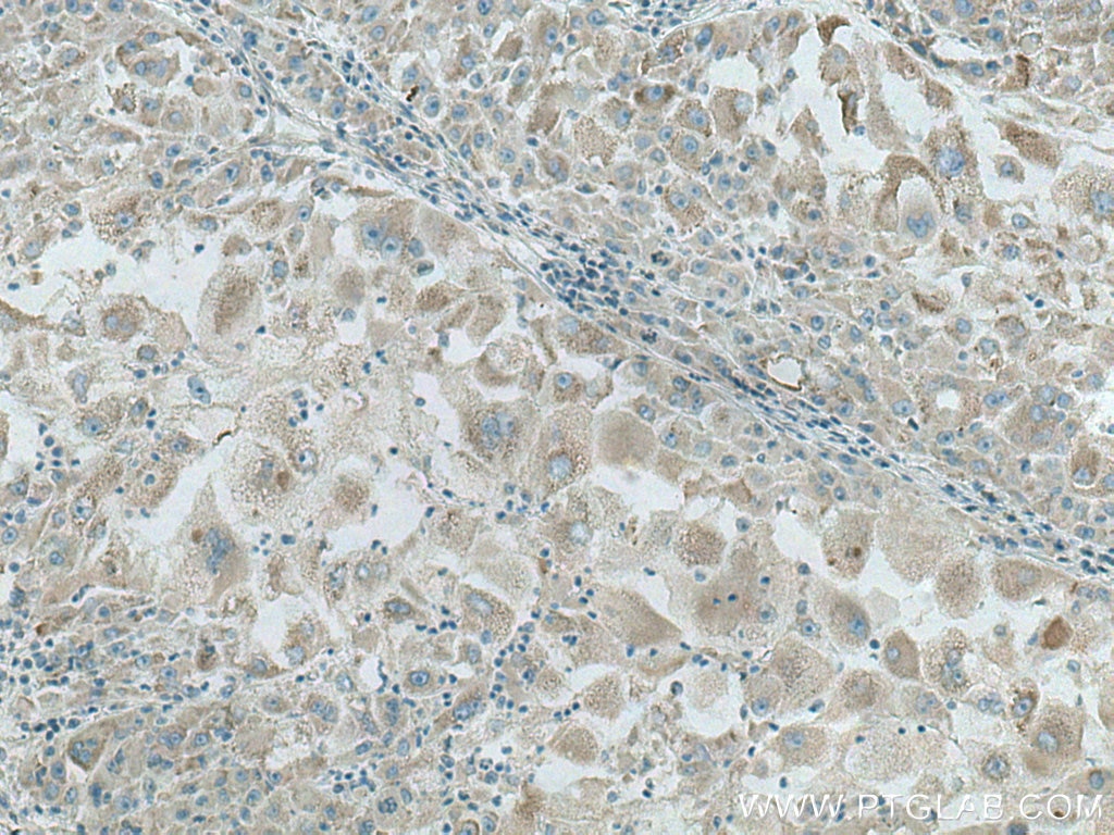 Immunohistochemistry (IHC) staining of human liver cancer tissue using PTPLAD1 Polyclonal antibody (28572-1-AP)