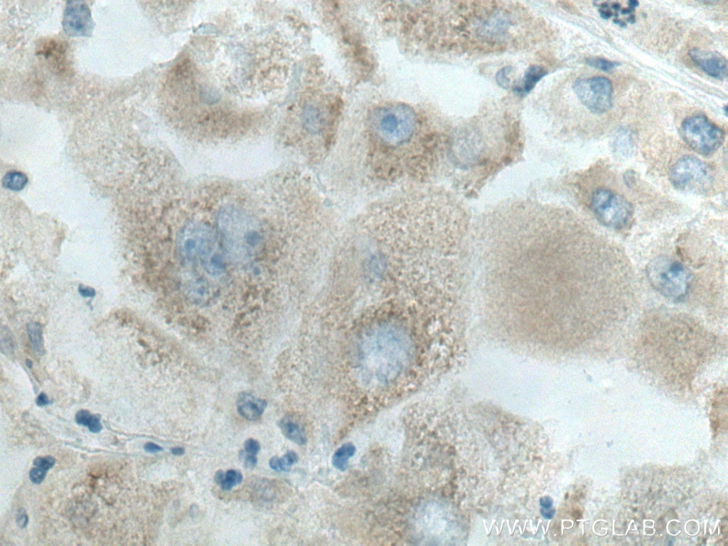 Immunohistochemistry (IHC) staining of human liver cancer tissue using PTPLAD1 Polyclonal antibody (28572-1-AP)