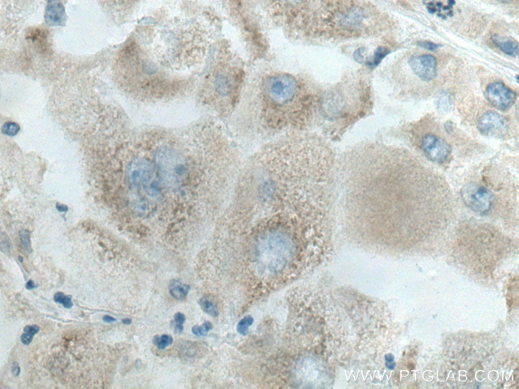 IHC staining of human liver cancer using 28572-1-AP