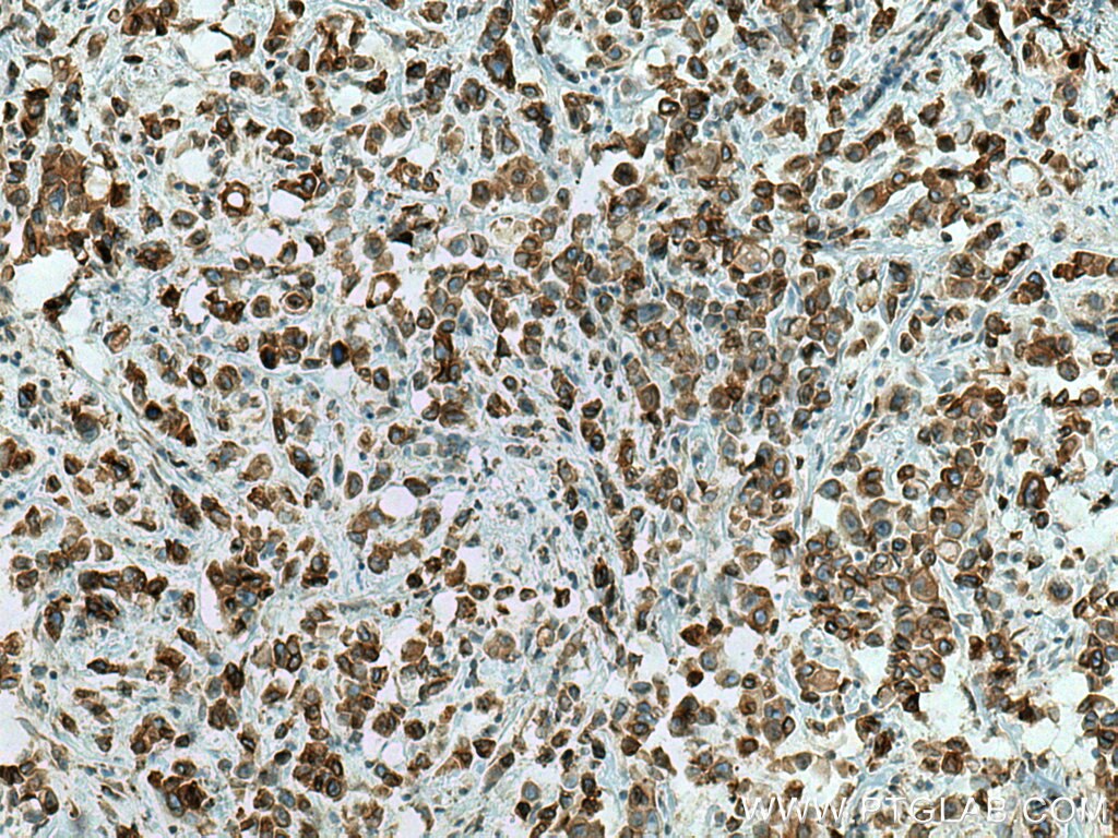 Immunohistochemistry (IHC) staining of human breast cancer tissue using PTPLAD1 Polyclonal antibody (28572-1-AP)