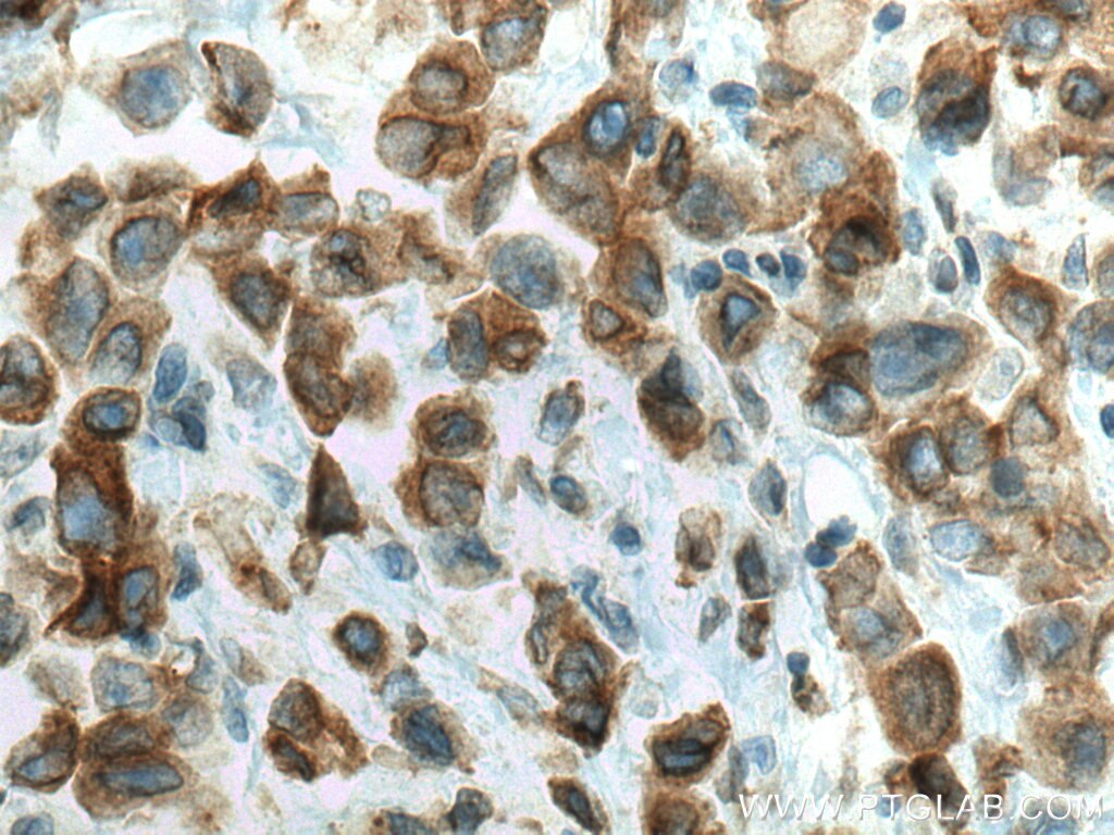 Immunohistochemistry (IHC) staining of human breast cancer tissue using PTPLAD1 Polyclonal antibody (28572-1-AP)