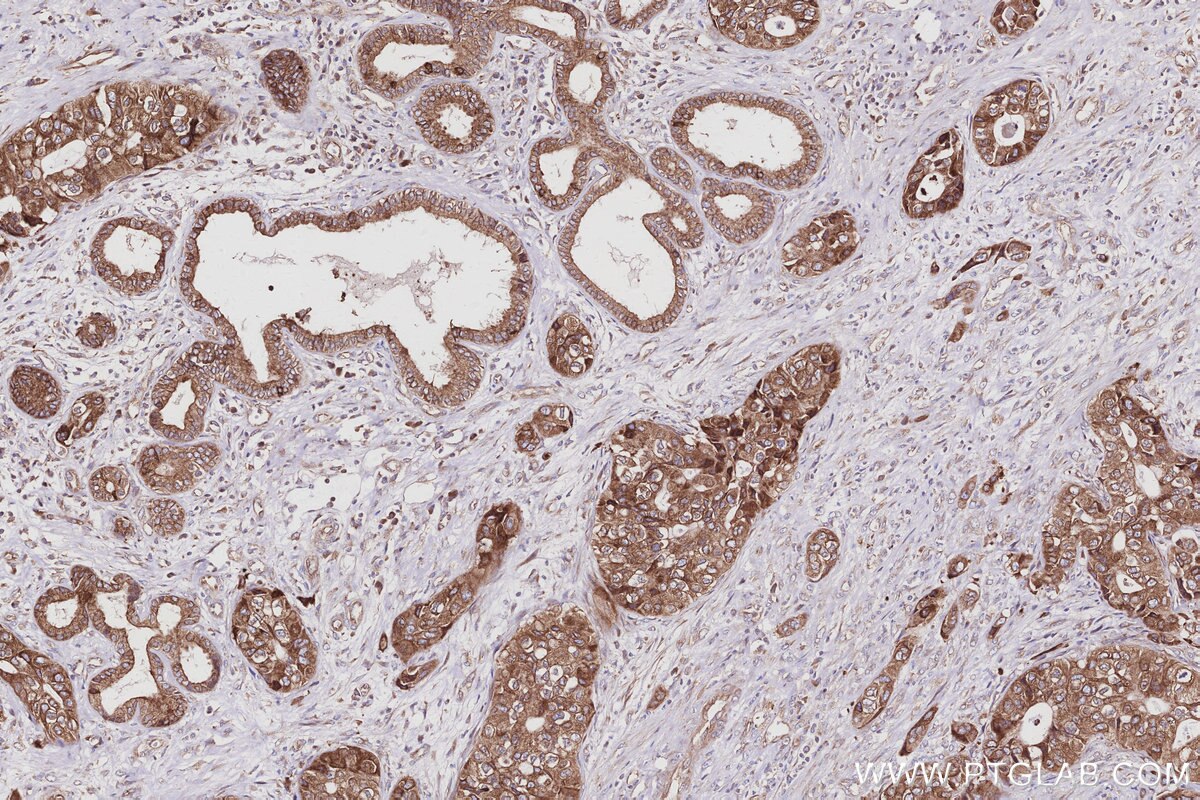 Immunohistochemistry (IHC) staining of human pancreas cancer tissue using PTPLAD1 Polyclonal antibody (28572-1-AP)