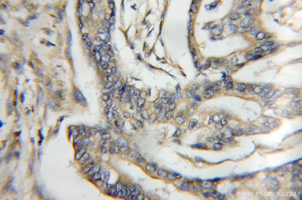 Immunohistochemistry (IHC) staining of human pancreas cancer tissue using PTPMT1 Polyclonal antibody (11493-1-AP)