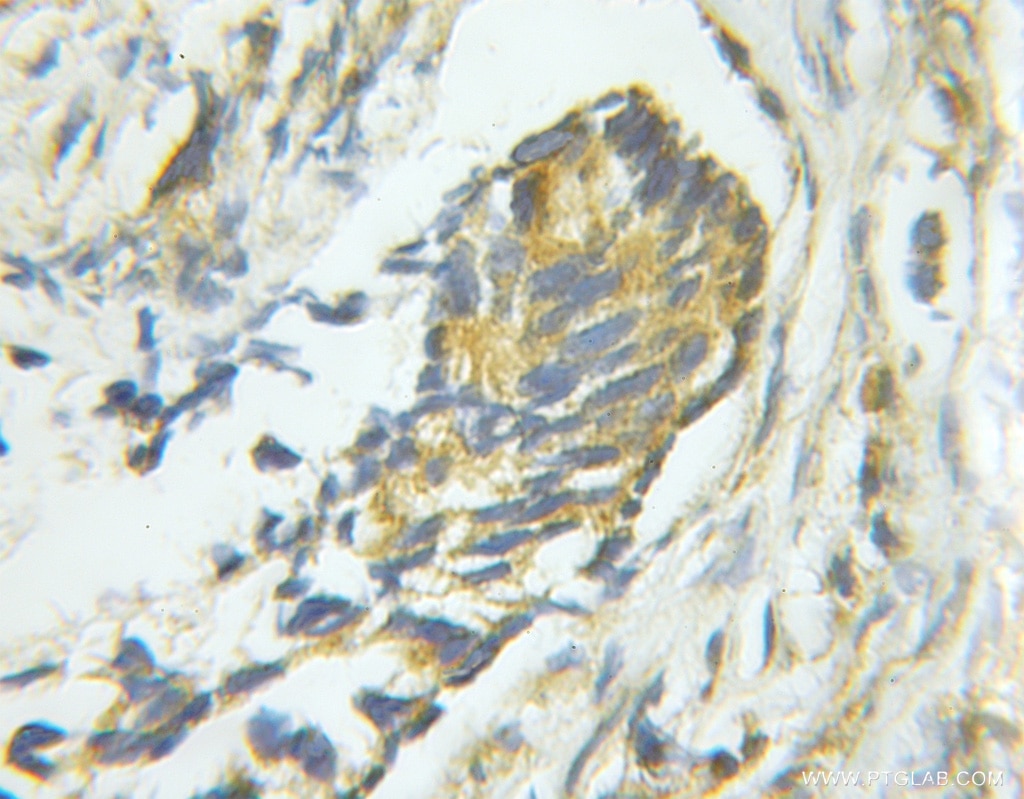 Immunohistochemistry (IHC) staining of human prostate cancer tissue using PTP1B Polyclonal antibody (11334-1-AP)
