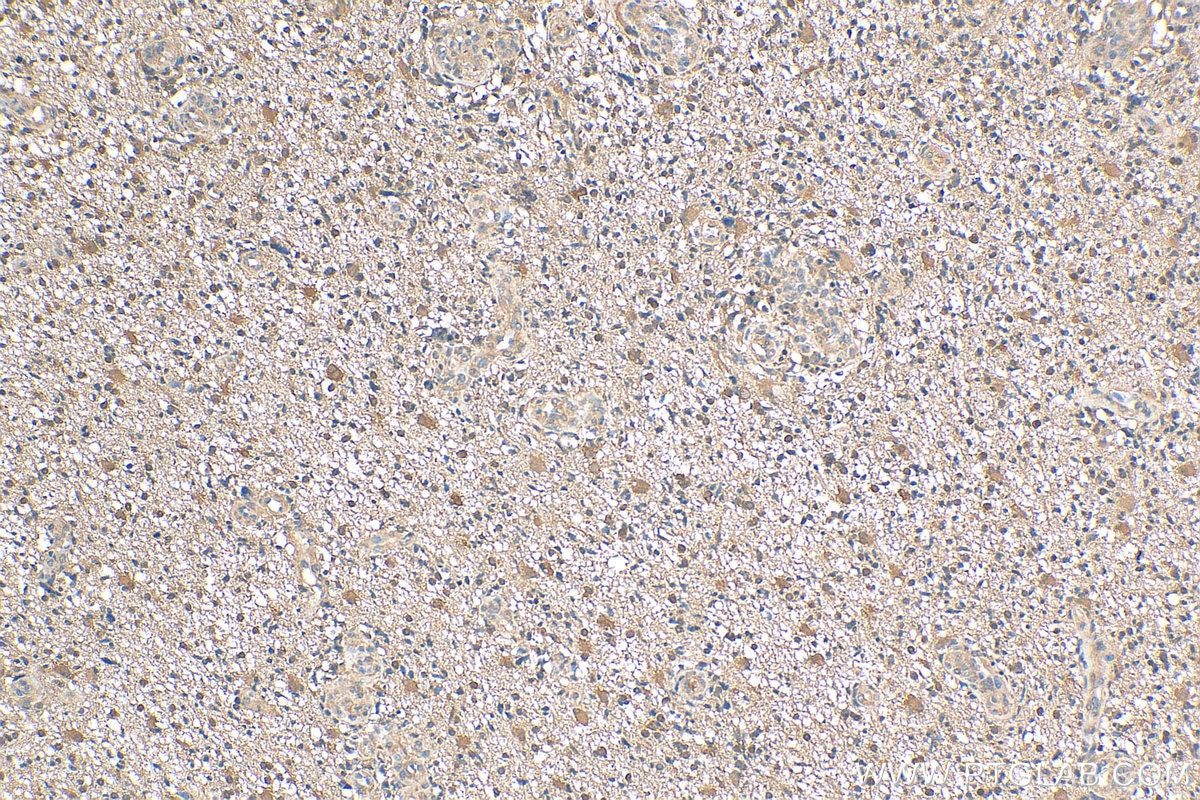 IHC staining of human gliomas using 20145-1-AP