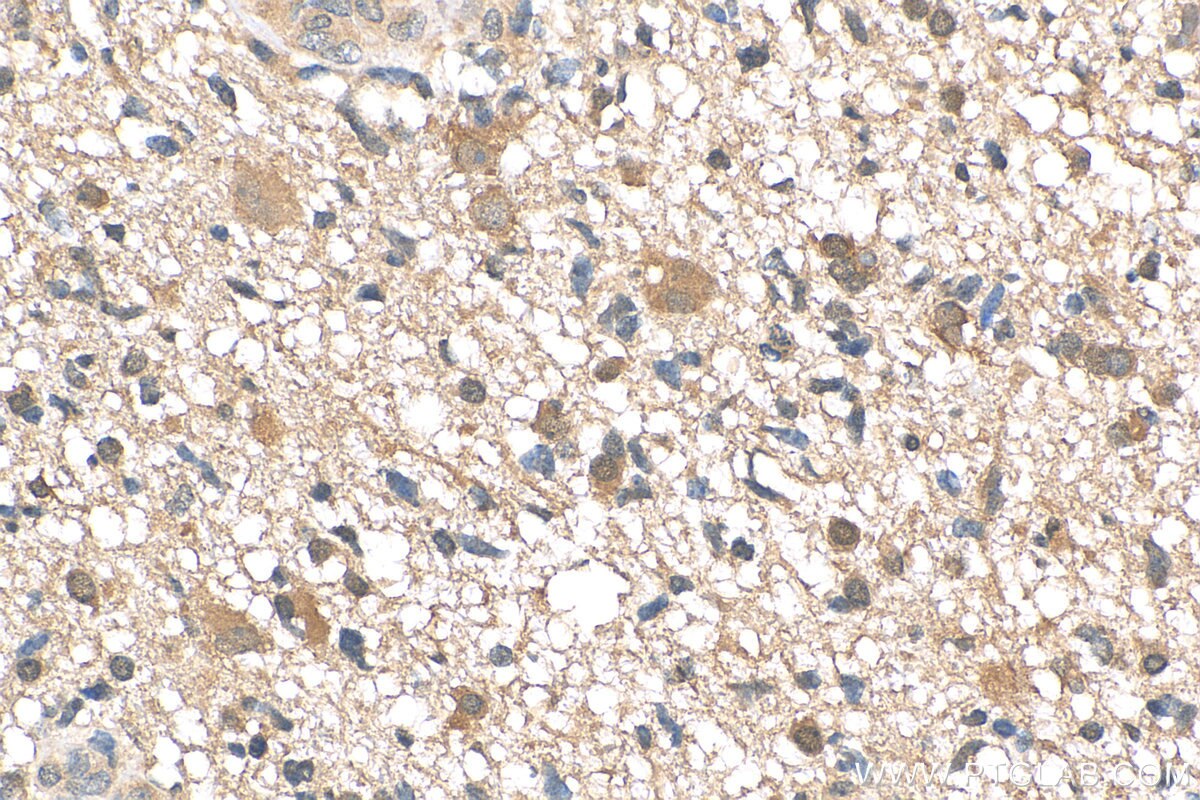 Immunohistochemistry (IHC) staining of human gliomas tissue using PTPN11/SHP2 Polyclonal antibody (20145-1-AP)