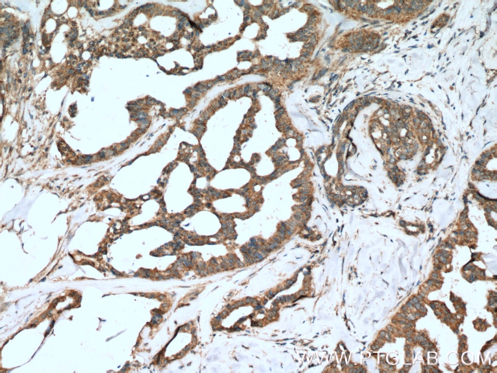 Immunohistochemistry (IHC) staining of human breast cancer tissue using PTPN11/SHP2 Polyclonal antibody (20145-1-AP)
