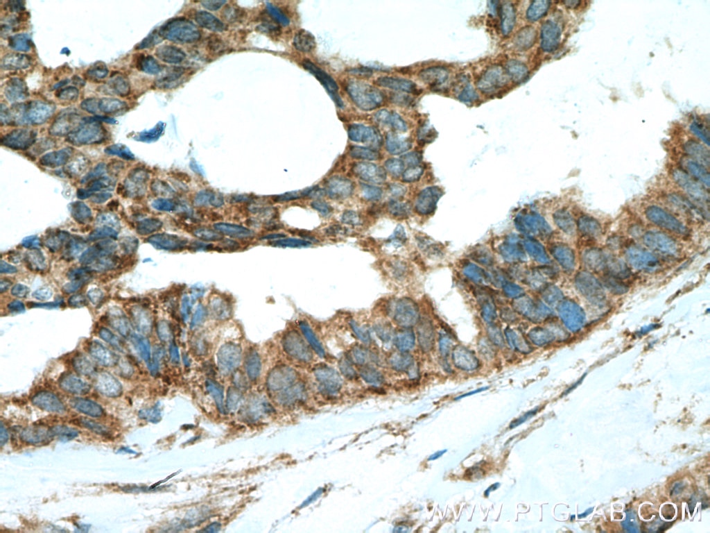 Immunohistochemistry (IHC) staining of human breast cancer tissue using PTPN11/SHP2 Polyclonal antibody (20145-1-AP)
