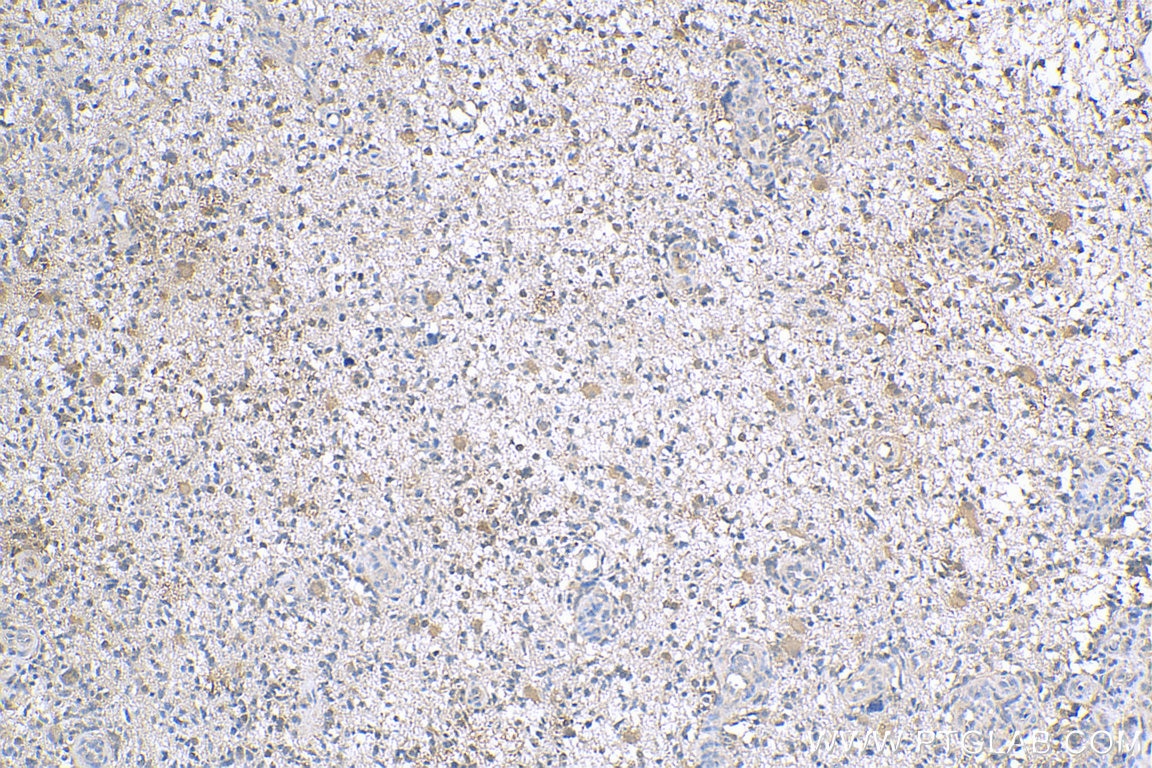 IHC staining of human gliomas using 24570-1-AP