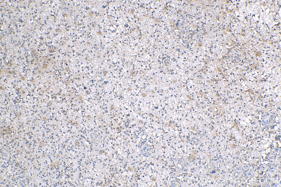 Immunohistochemistry (IHC) staining of human gliomas tissue using SHP2 Polyclonal antibody (24570-1-AP)