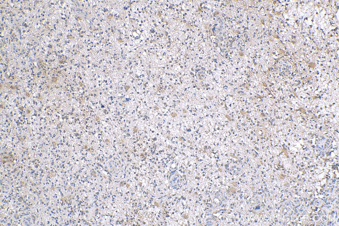 Immunohistochemistry (IHC) staining of human gliomas tissue using PTPN11/SHP2 Polyclonal antibody (24570-1-AP)