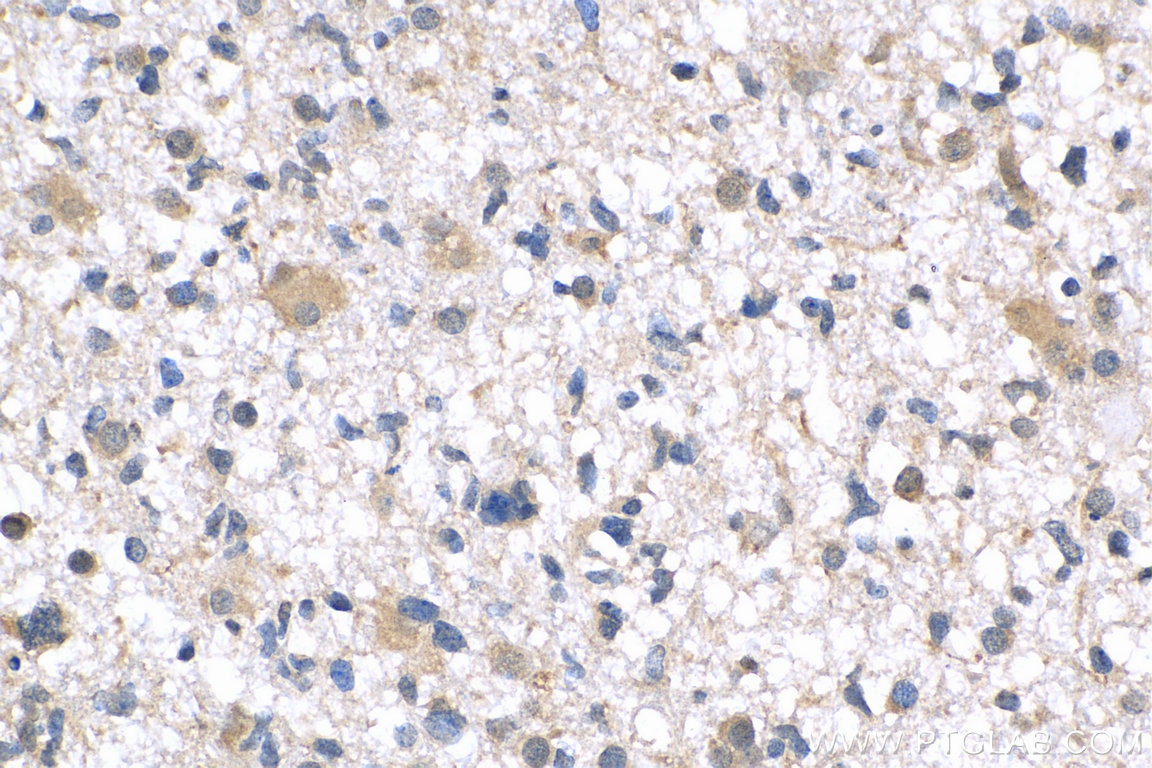Immunohistochemistry (IHC) staining of human gliomas tissue using PTPN11 Polyclonal antibody (24570-1-AP)