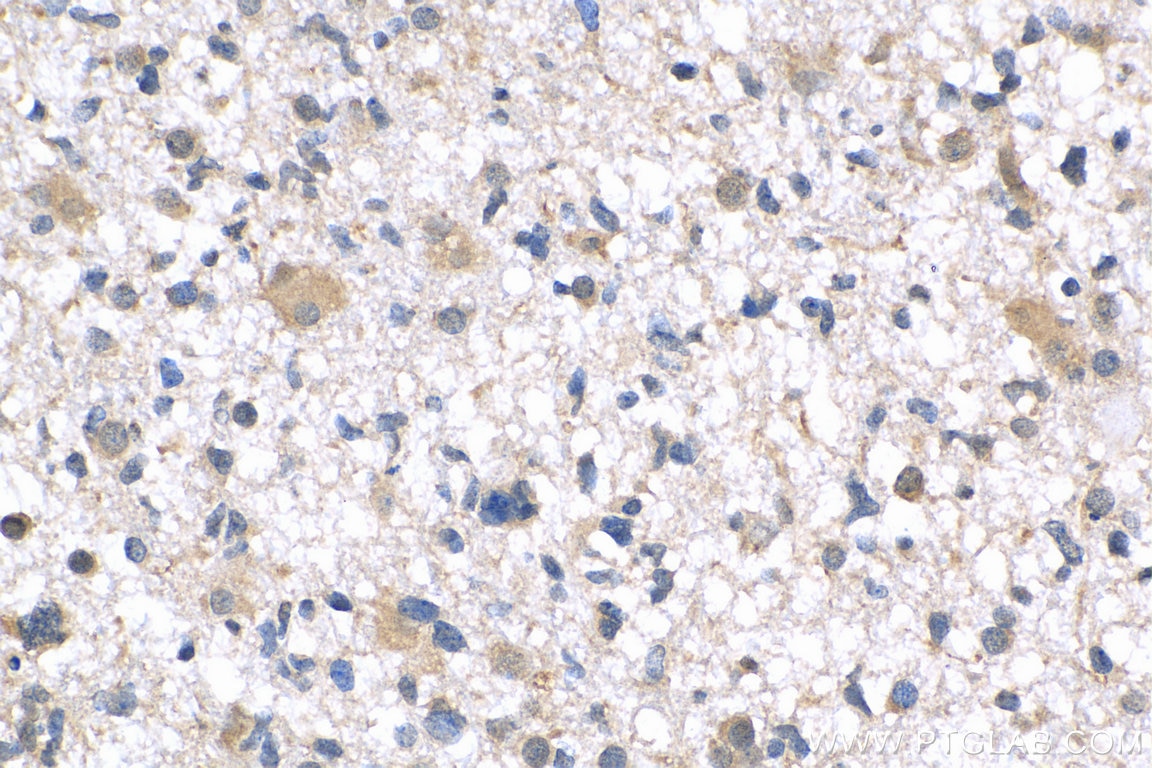 Immunohistochemistry (IHC) staining of human gliomas tissue using SHP2 Polyclonal antibody (24570-1-AP)