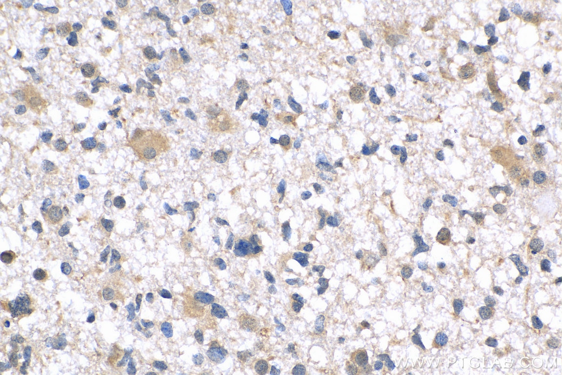 Immunohistochemistry (IHC) staining of human gliomas tissue using PTPN11/SHP2 Polyclonal antibody (24570-1-AP)