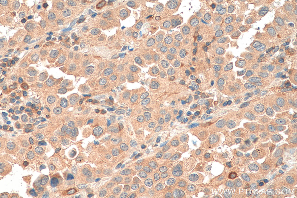 Immunohistochemistry (IHC) staining of human lung cancer tissue using PTPN13 Polyclonal antibody (25944-1-AP)