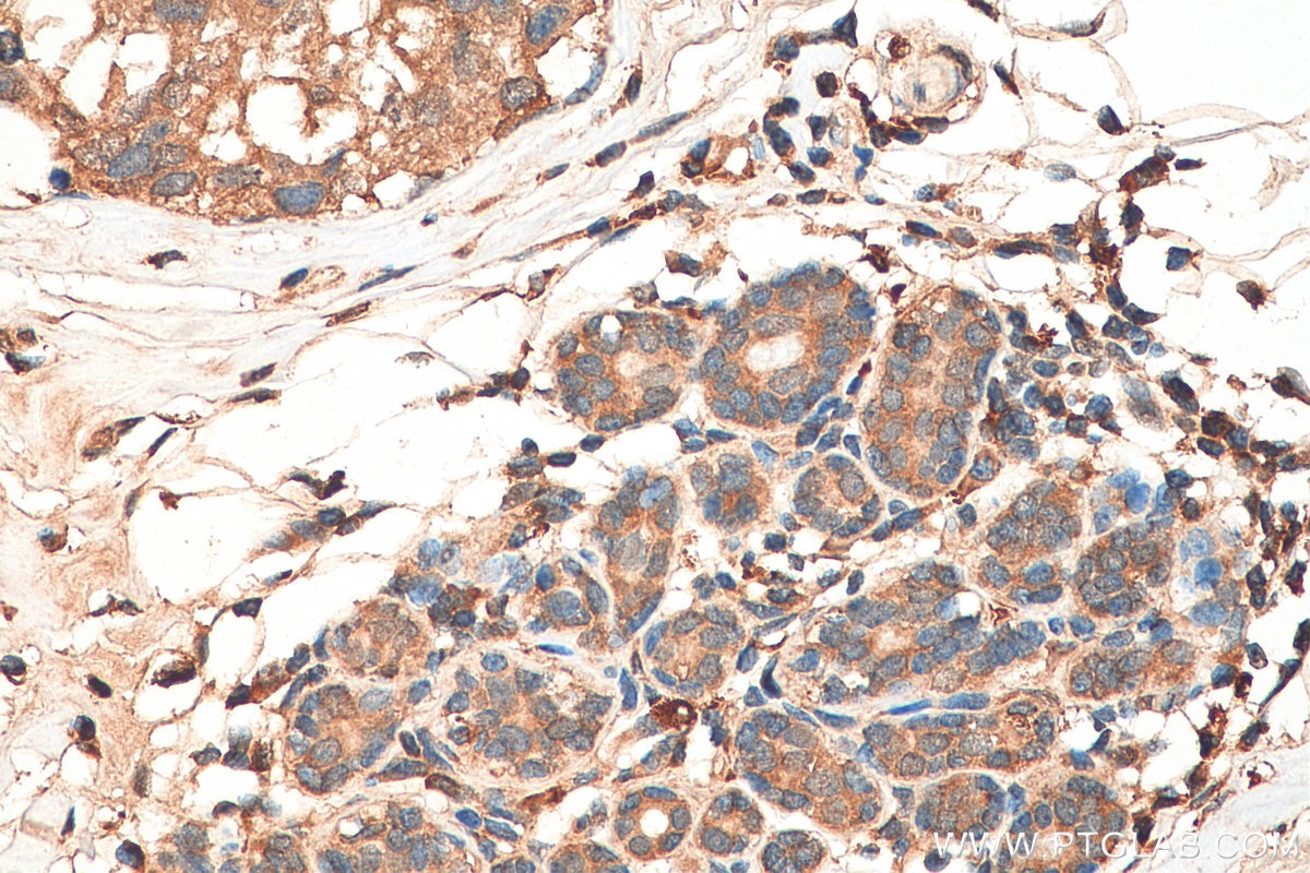 Immunohistochemistry (IHC) staining of human breast cancer tissue using PTPN13 Polyclonal antibody (25944-1-AP)