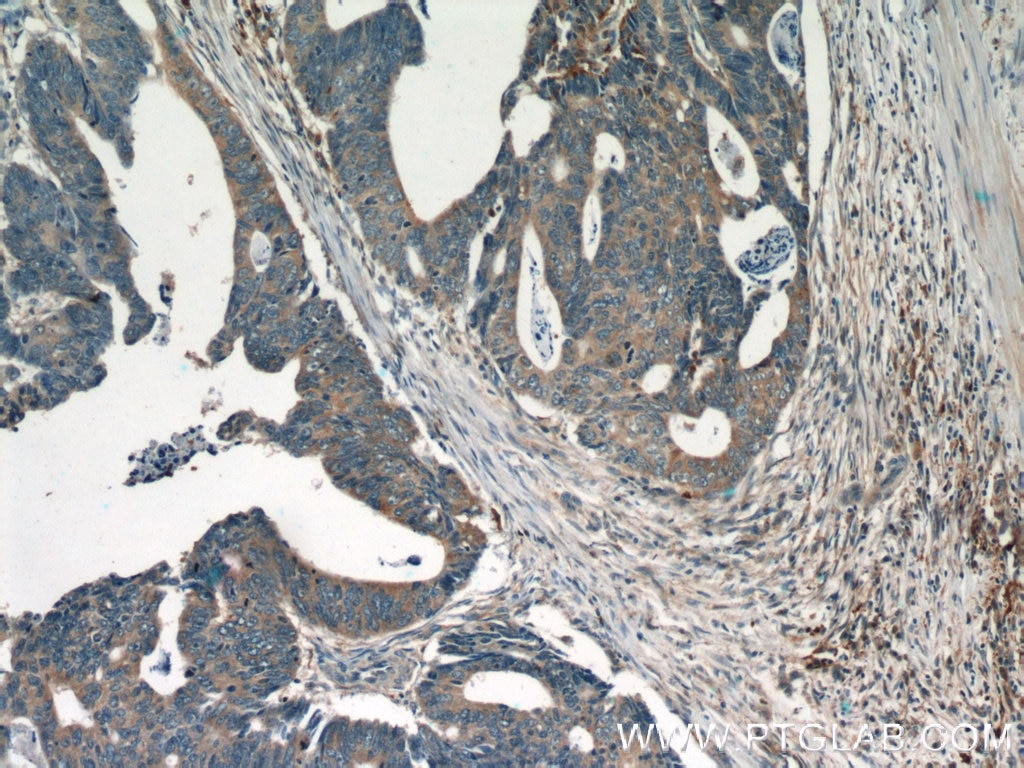 Immunohistochemistry (IHC) staining of human colon cancer tissue using PTPN2 Polyclonal antibody (11214-1-AP)