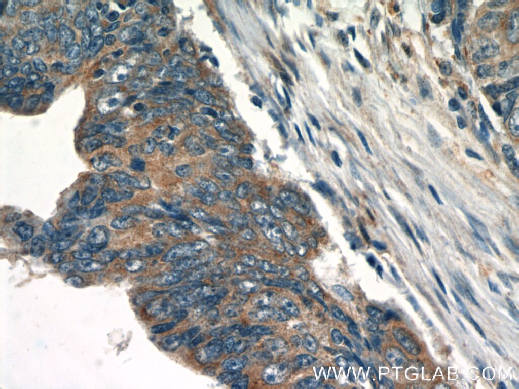 Immunohistochemistry (IHC) staining of human colon cancer tissue using PTPN2 Polyclonal antibody (11214-1-AP)