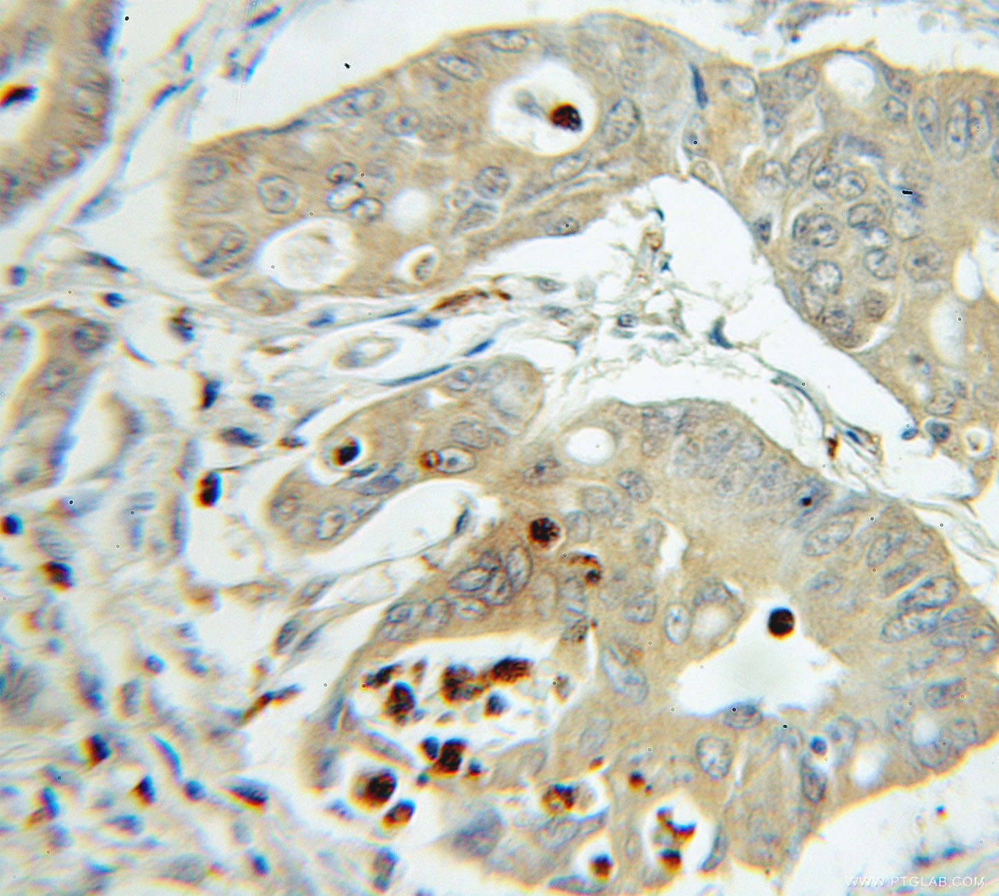 Immunohistochemistry (IHC) staining of human colon cancer tissue using PTPN2 Polyclonal antibody (11214-1-AP)