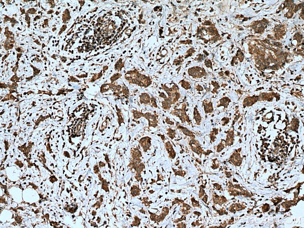Immunohistochemistry (IHC) staining of human breast cancer tissue using PTPN2 Monoclonal antibody (67388-1-Ig)