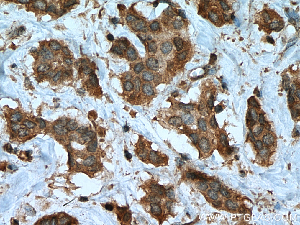 Immunohistochemistry (IHC) staining of human breast cancer tissue using PTPN2 Monoclonal antibody (67388-1-Ig)
