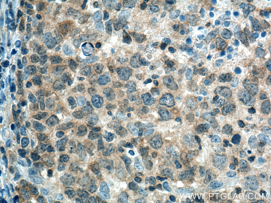 Immunohistochemistry (IHC) staining of human lymphoma tissue using PTPN22 Polyclonal antibody (11783-1-AP)