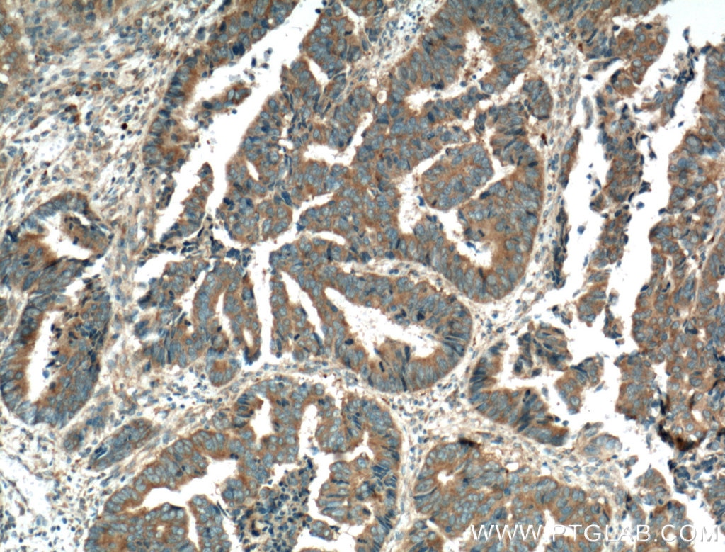 Immunohistochemistry (IHC) staining of human colon cancer tissue using PTPN23 Polyclonal antibody (10472-1-AP)