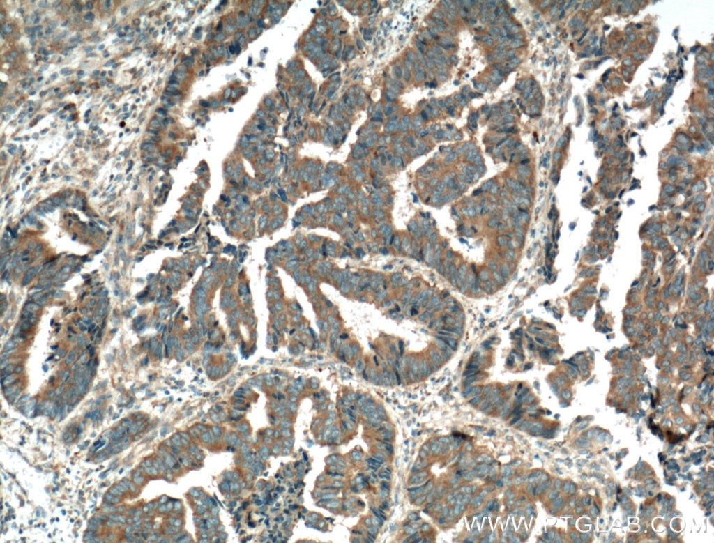 Immunohistochemistry (IHC) staining of human colon cancer tissue using PTPN23 Polyclonal antibody (10472-1-AP)