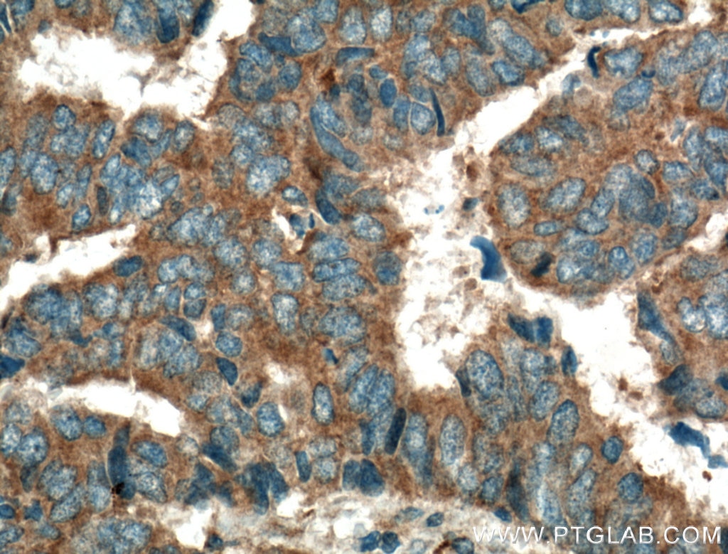 Immunohistochemistry (IHC) staining of human colon cancer tissue using PTPN23 Polyclonal antibody (10472-1-AP)