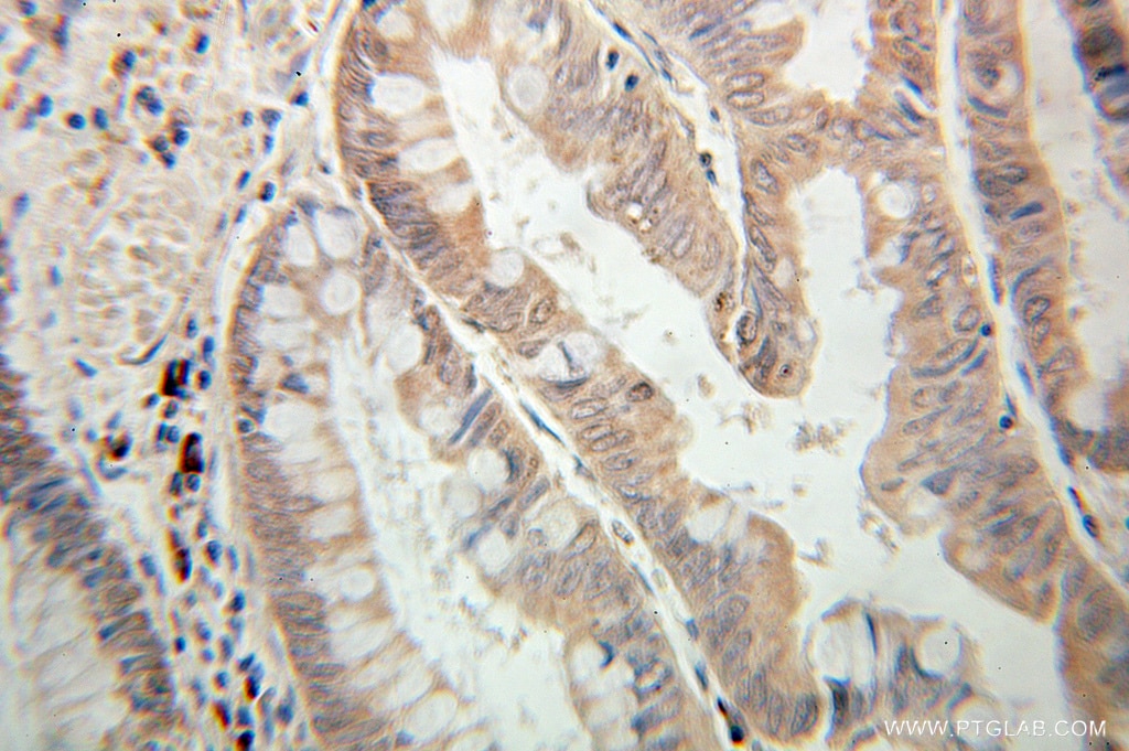 Immunohistochemistry (IHC) staining of human colon cancer tissue using PTPN23 Polyclonal antibody (10472-1-AP)