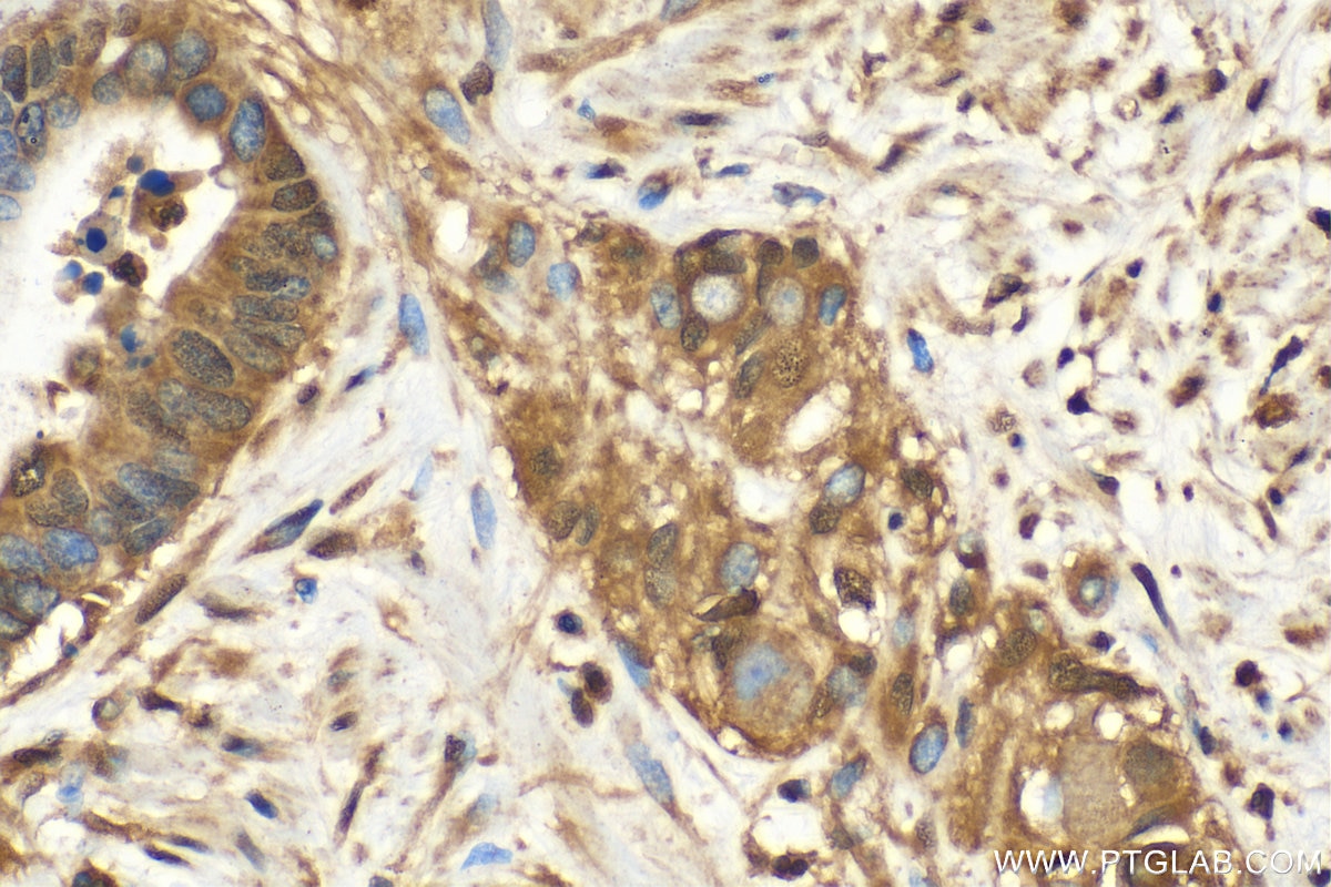 Immunohistochemistry (IHC) staining of human colon cancer tissue using PTPN6 Polyclonal antibody (24546-1-AP)