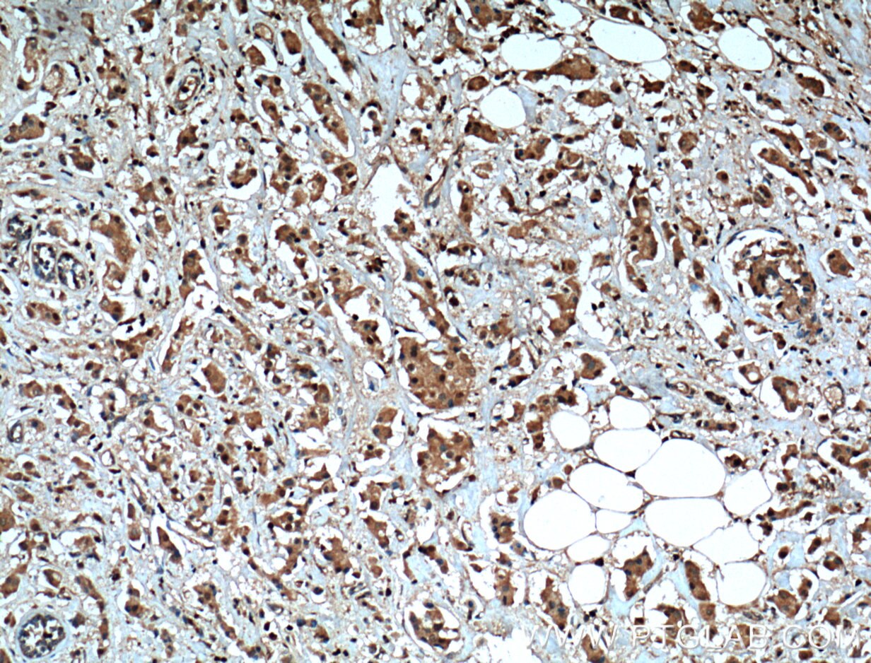 Immunohistochemistry (IHC) staining of human breast cancer tissue using PTPN6 Polyclonal antibody (24546-1-AP)