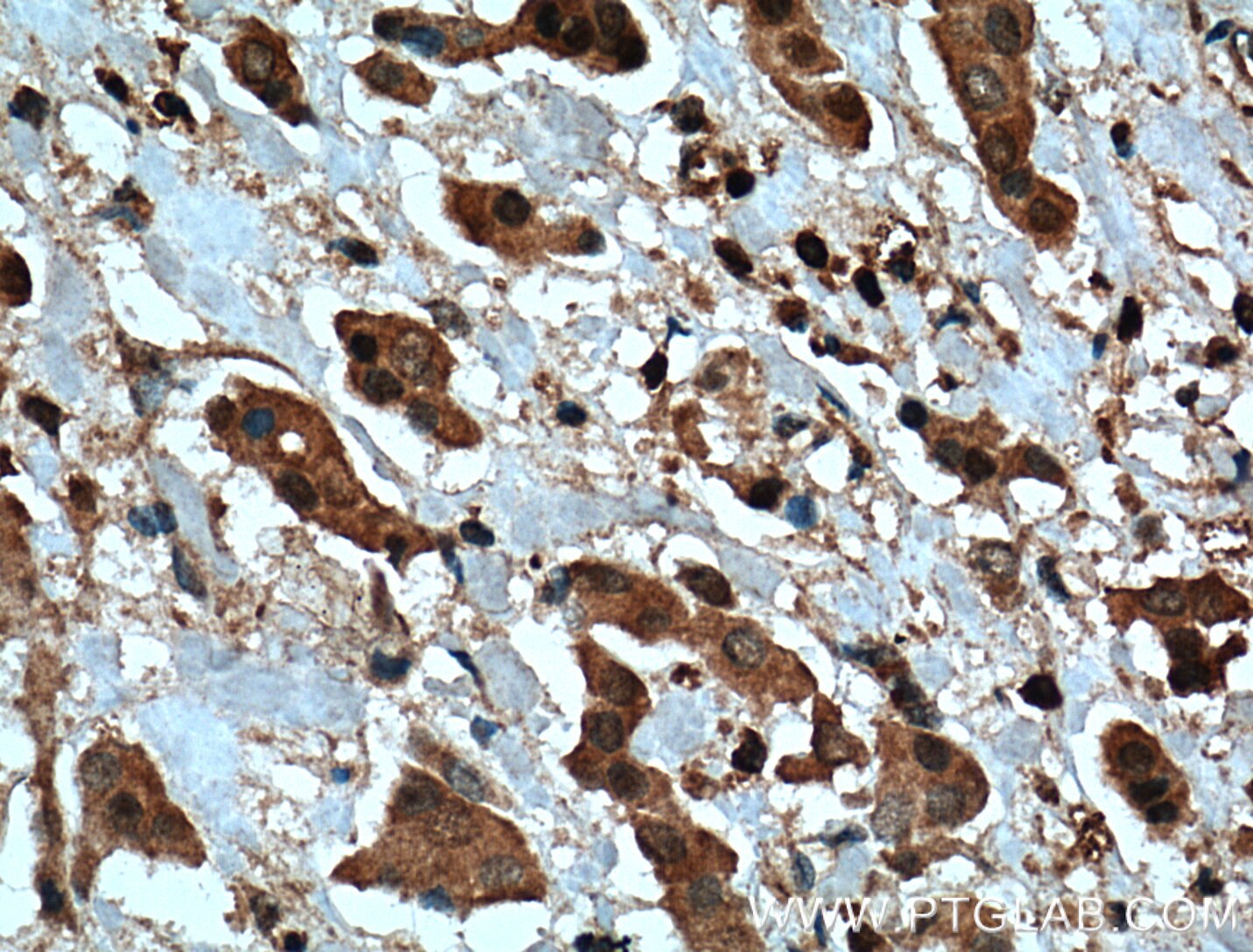 Immunohistochemistry (IHC) staining of human breast cancer tissue using PTPN6 Polyclonal antibody (24546-1-AP)