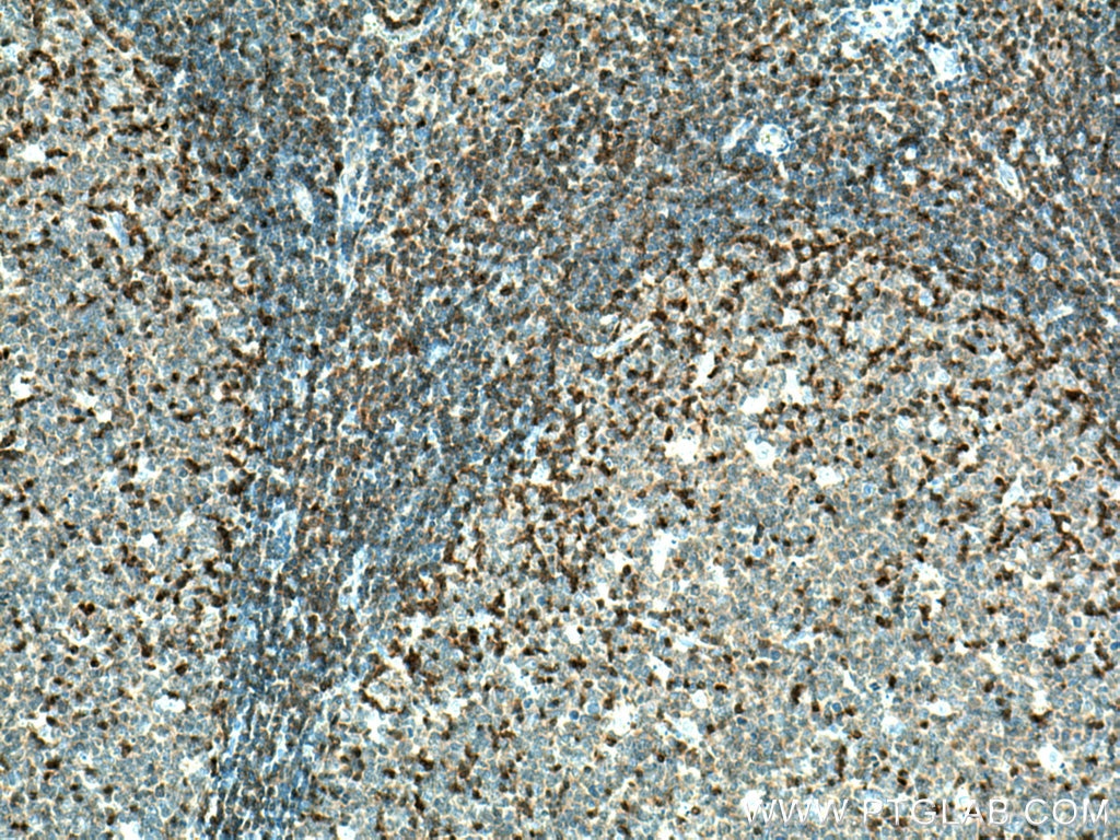 Immunohistochemistry (IHC) staining of human tonsillitis tissue using PTPN7 Polyclonal antibody (15286-1-AP)