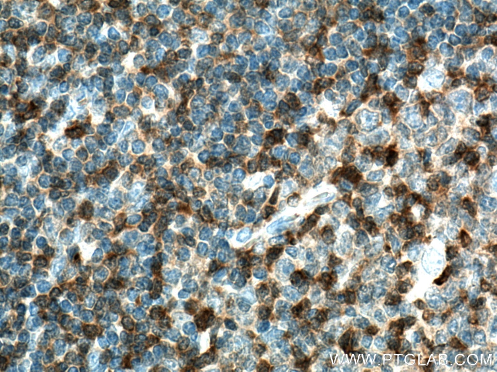 Immunohistochemistry (IHC) staining of human tonsillitis tissue using PTPN7 Polyclonal antibody (15286-1-AP)