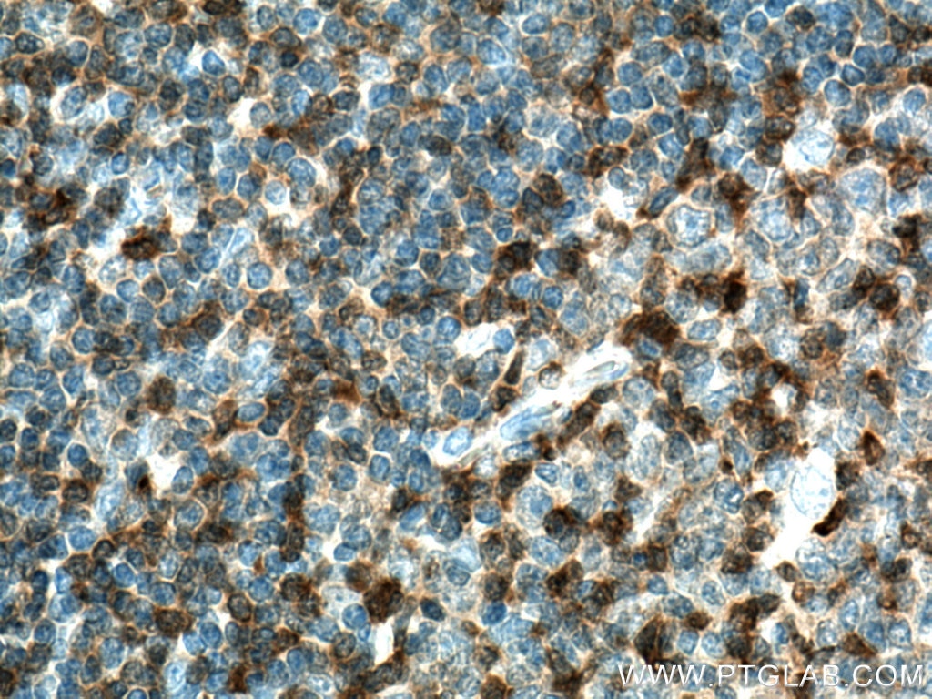 IHC staining of human tonsillitis using 15286-1-AP