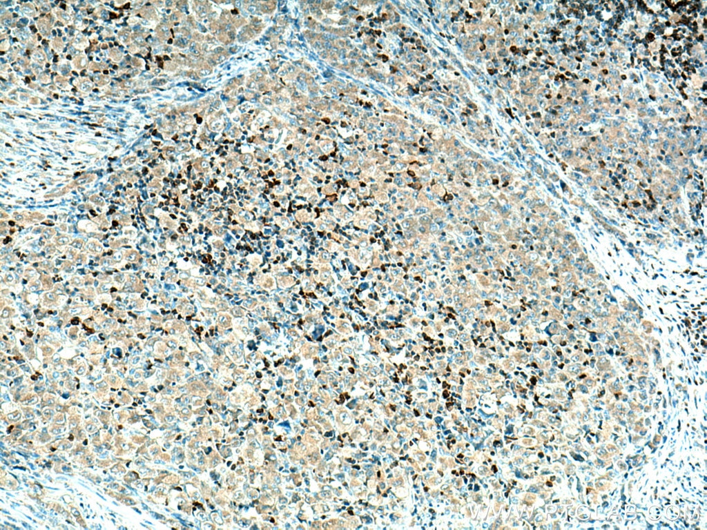 Immunohistochemistry (IHC) staining of human lymphoma tissue using PTPN7 Polyclonal antibody (15286-1-AP)