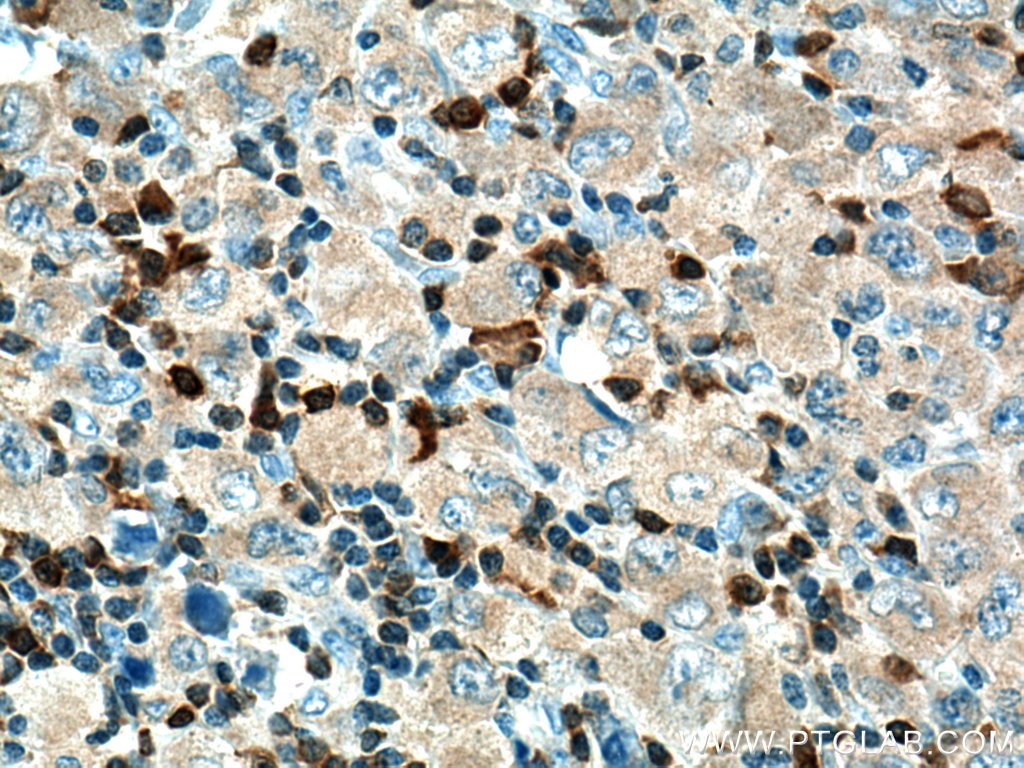 Immunohistochemistry (IHC) staining of human lymphoma tissue using PTPN7 Polyclonal antibody (15286-1-AP)