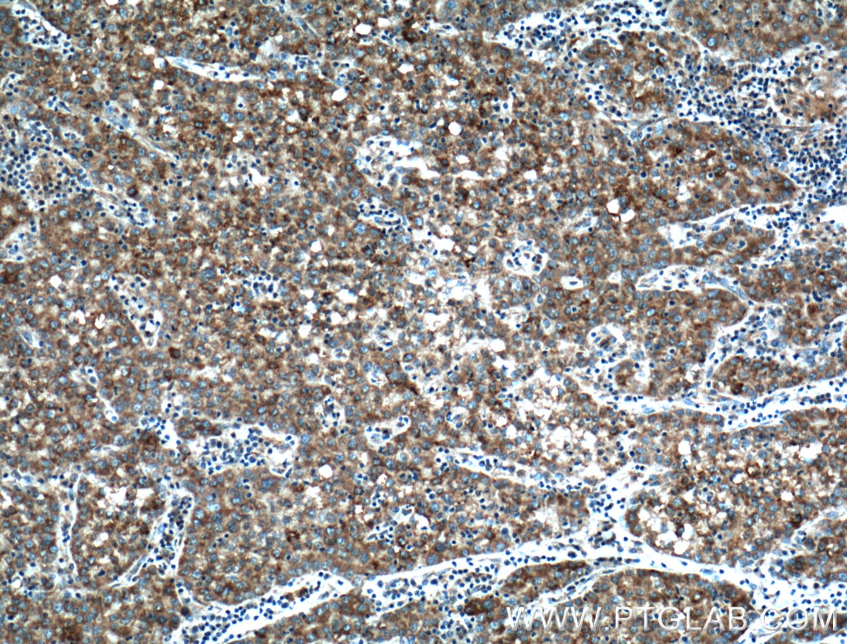 Immunohistochemistry (IHC) staining of human liver cancer tissue using PTPN9 Polyclonal antibody (12109-1-AP)
