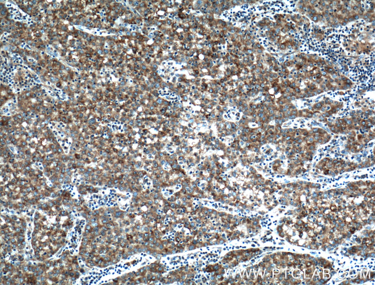 IHC staining of human liver cancer using 12109-1-AP