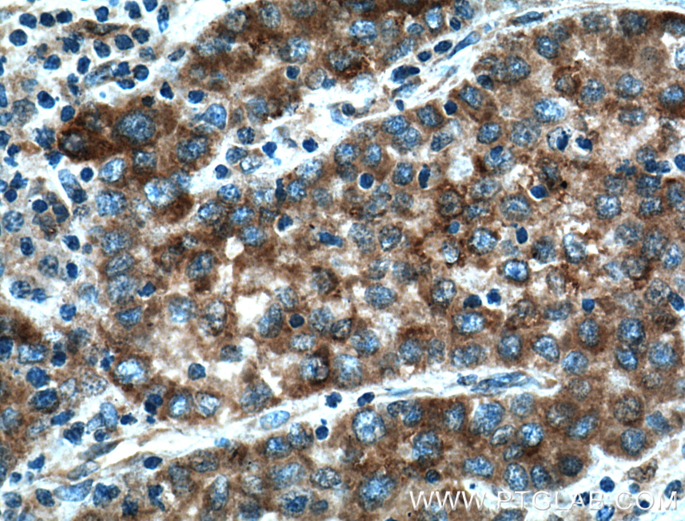 Immunohistochemistry (IHC) staining of human liver cancer tissue using PTPN9 Polyclonal antibody (12109-1-AP)