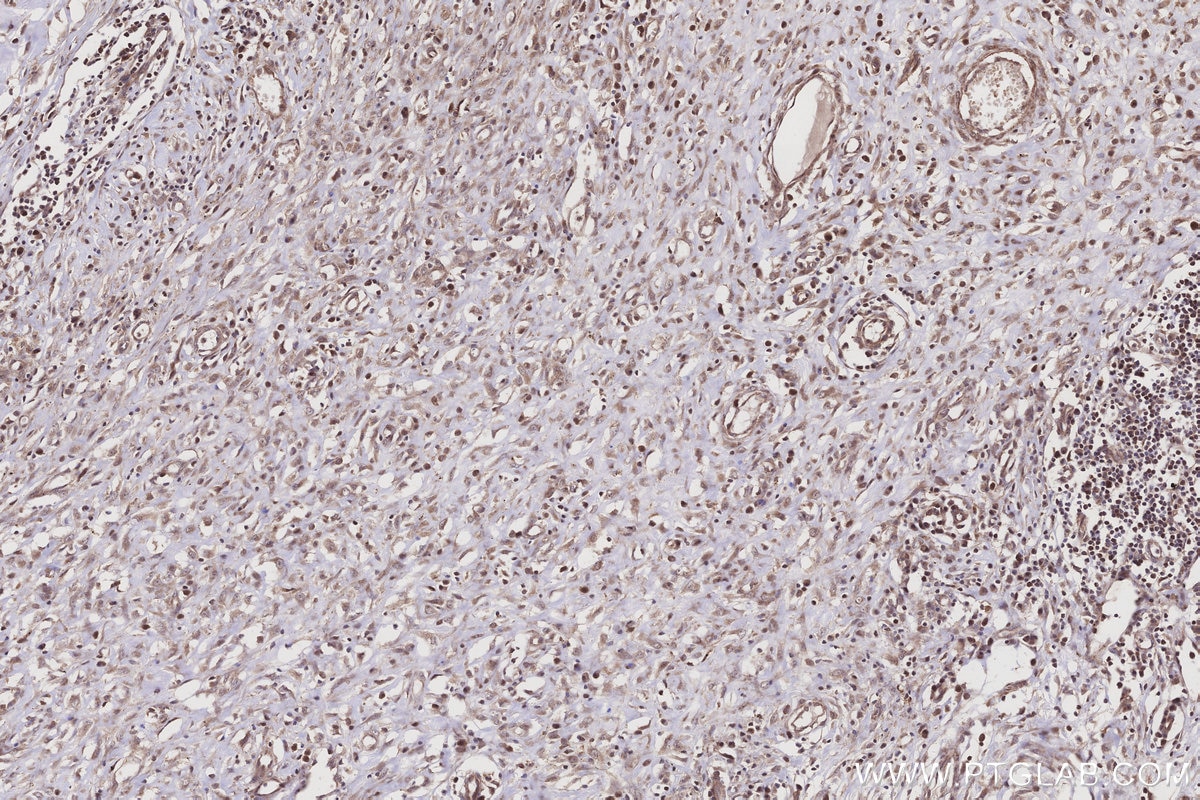 Immunohistochemistry (IHC) staining of human colon cancer tissue using PTPN9 Polyclonal antibody (12109-1-AP)