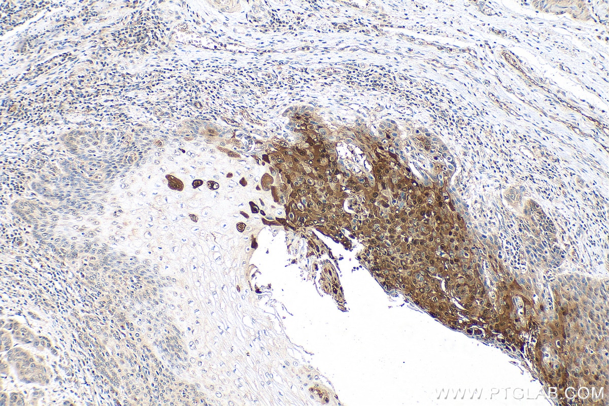 IHC staining of human oesophagus cancer using 30282-1-AP