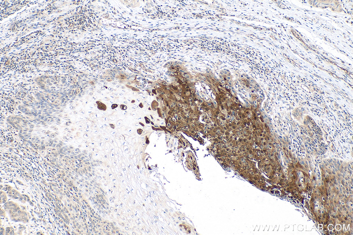 Immunohistochemistry (IHC) staining of human oesophagus cancer tissue using PTPN9 Polyclonal antibody (30282-1-AP)