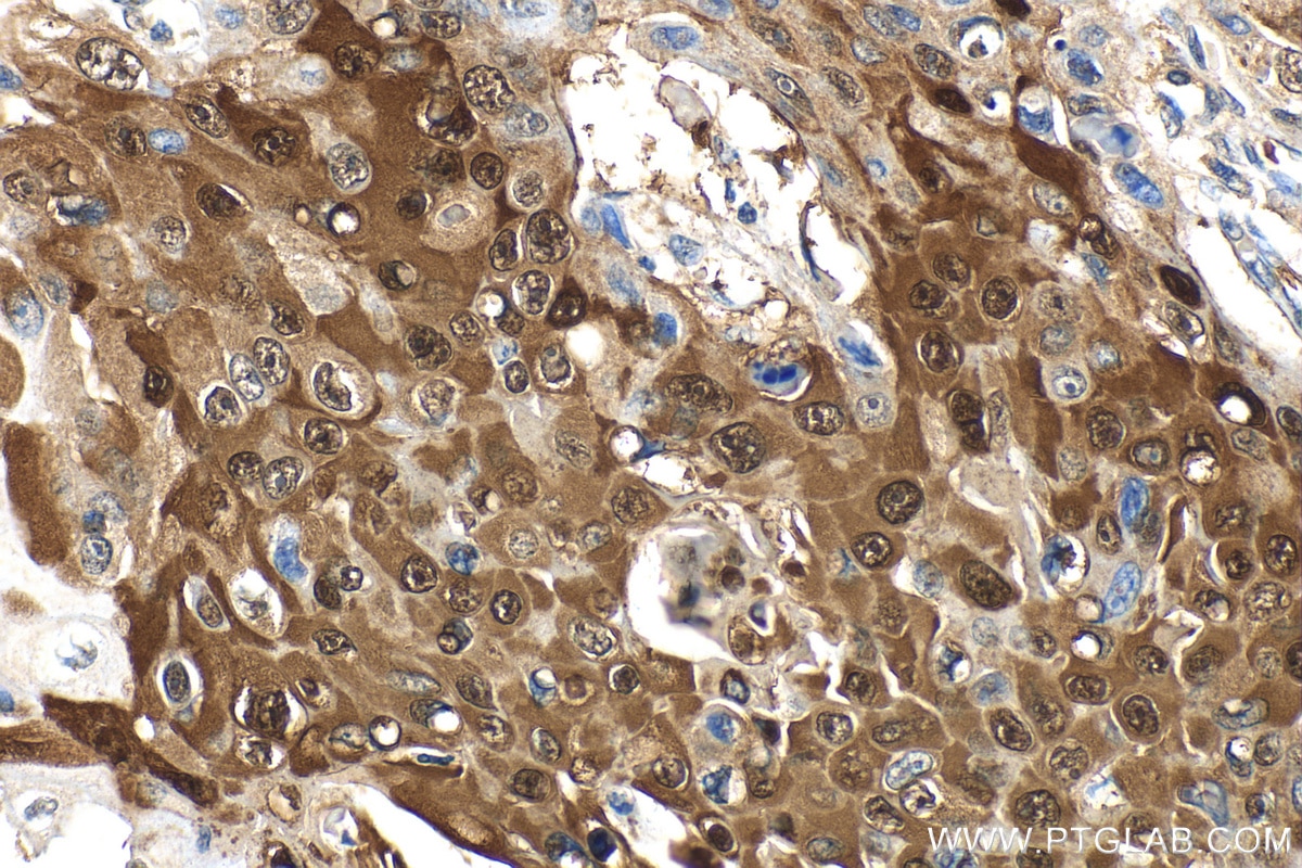 Immunohistochemistry (IHC) staining of human oesophagus cancer tissue using PTPN9 Polyclonal antibody (30282-1-AP)