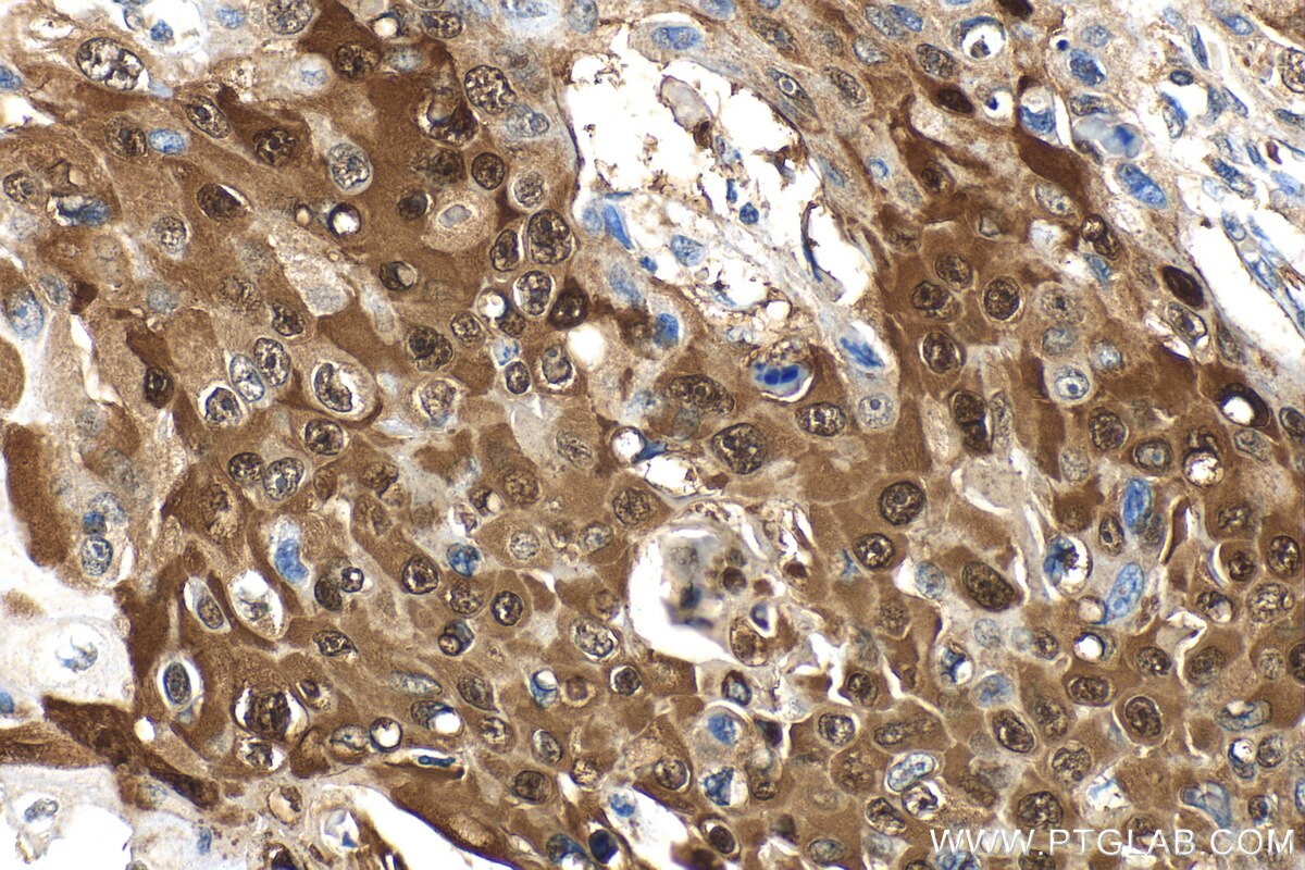 Immunohistochemistry (IHC) staining of human oesophagus cancer tissue using PTPN9 Polyclonal antibody (30282-1-AP)