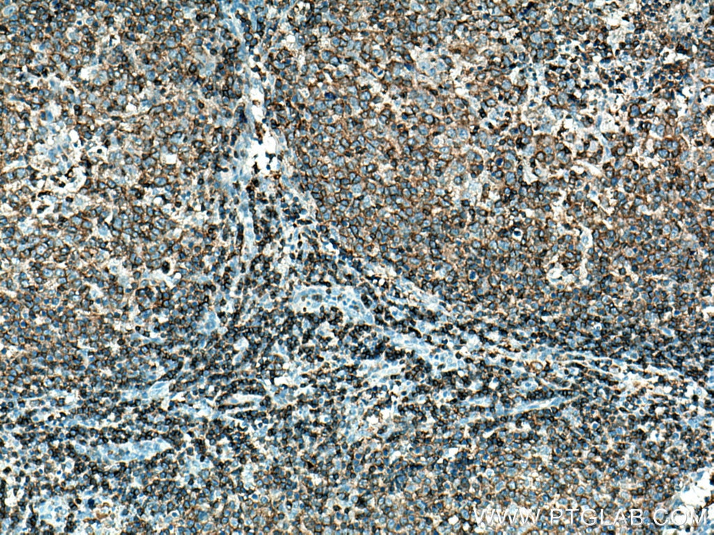 IHC staining of human lymphoma using 19715-1-AP