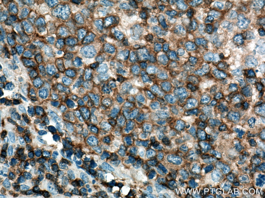 IHC staining of human lymphoma using 19715-1-AP